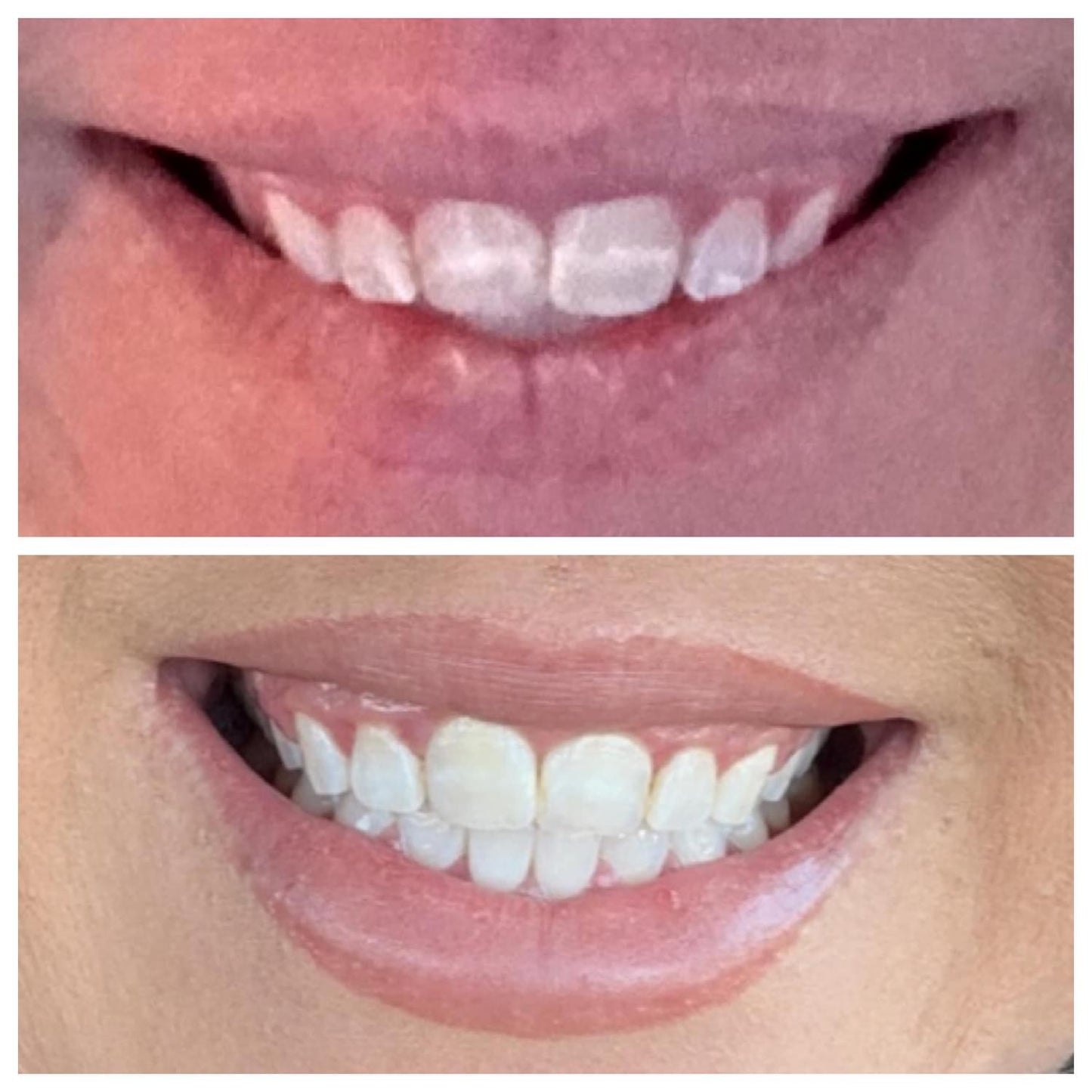 Teeth Whitening Gel